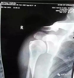 肩关节半脱位复位视频,肩关节半脱位复位操作步骤详解